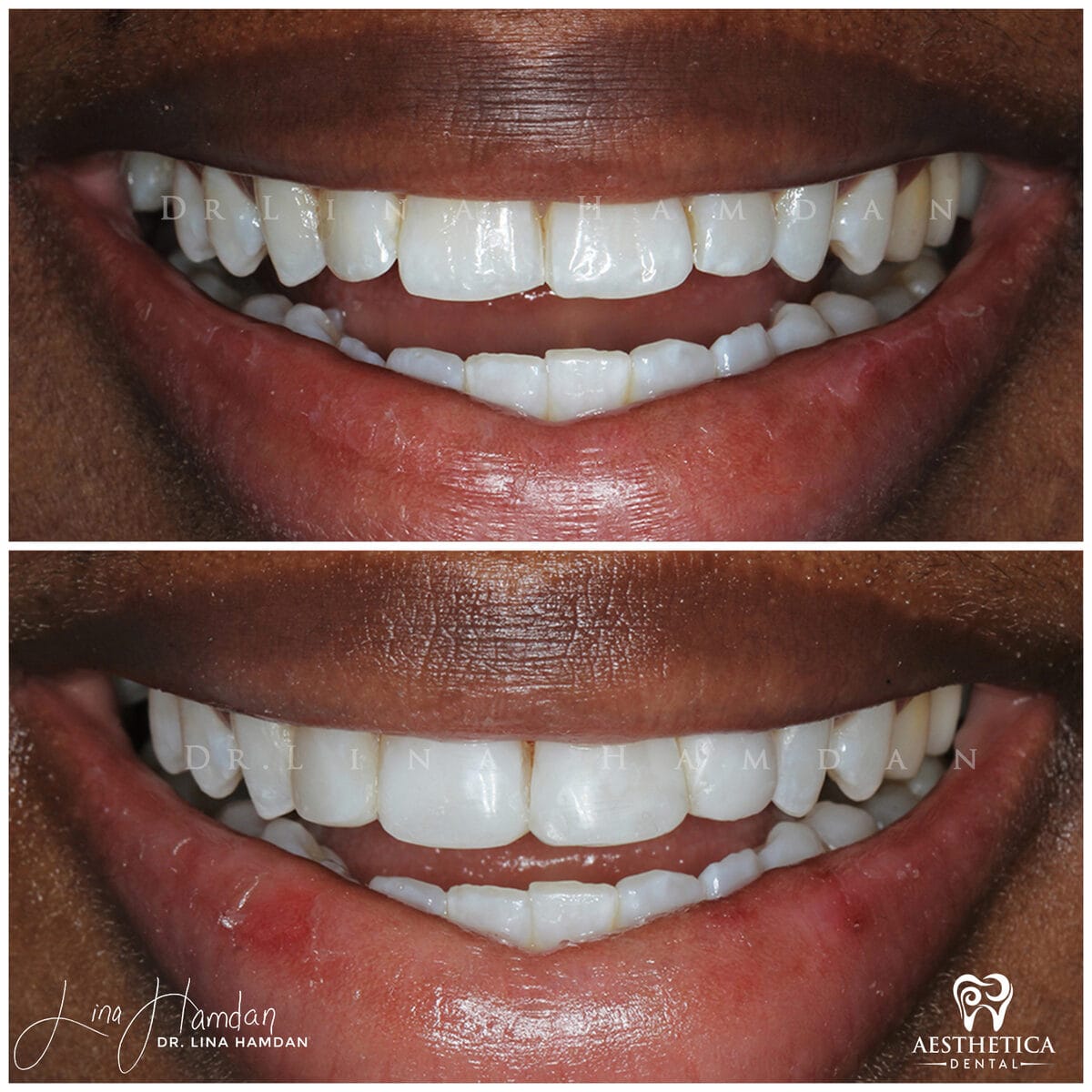 Composite bonding: anonymous case 59 from Aesthetica Dental Naperville