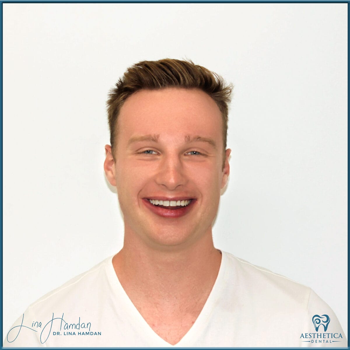 Composite bonding: anonymous case 81 from Aesthetica Dental Naperville