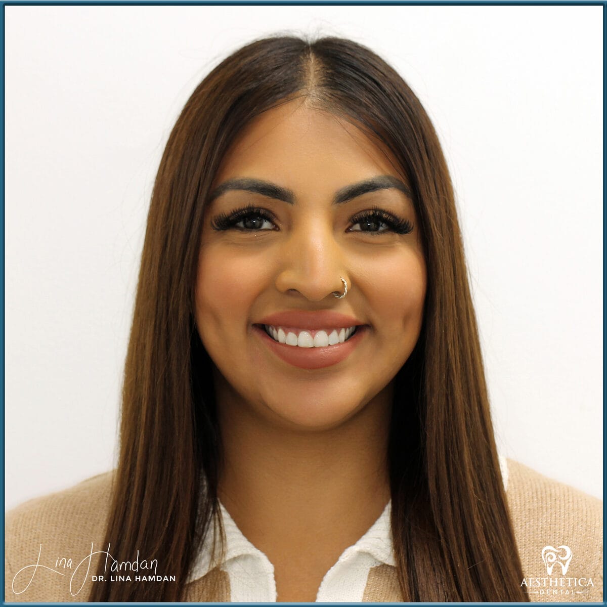 Composite bonding: anonymous case 85 from Aesthetica Dental Naperville
