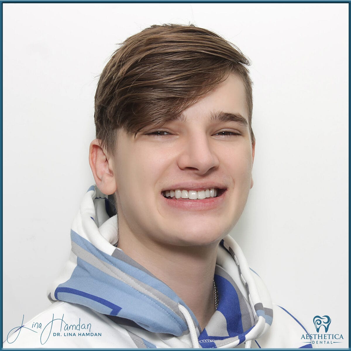 Composite bonding: anonymous case 86 from Aesthetica Dental Naperville