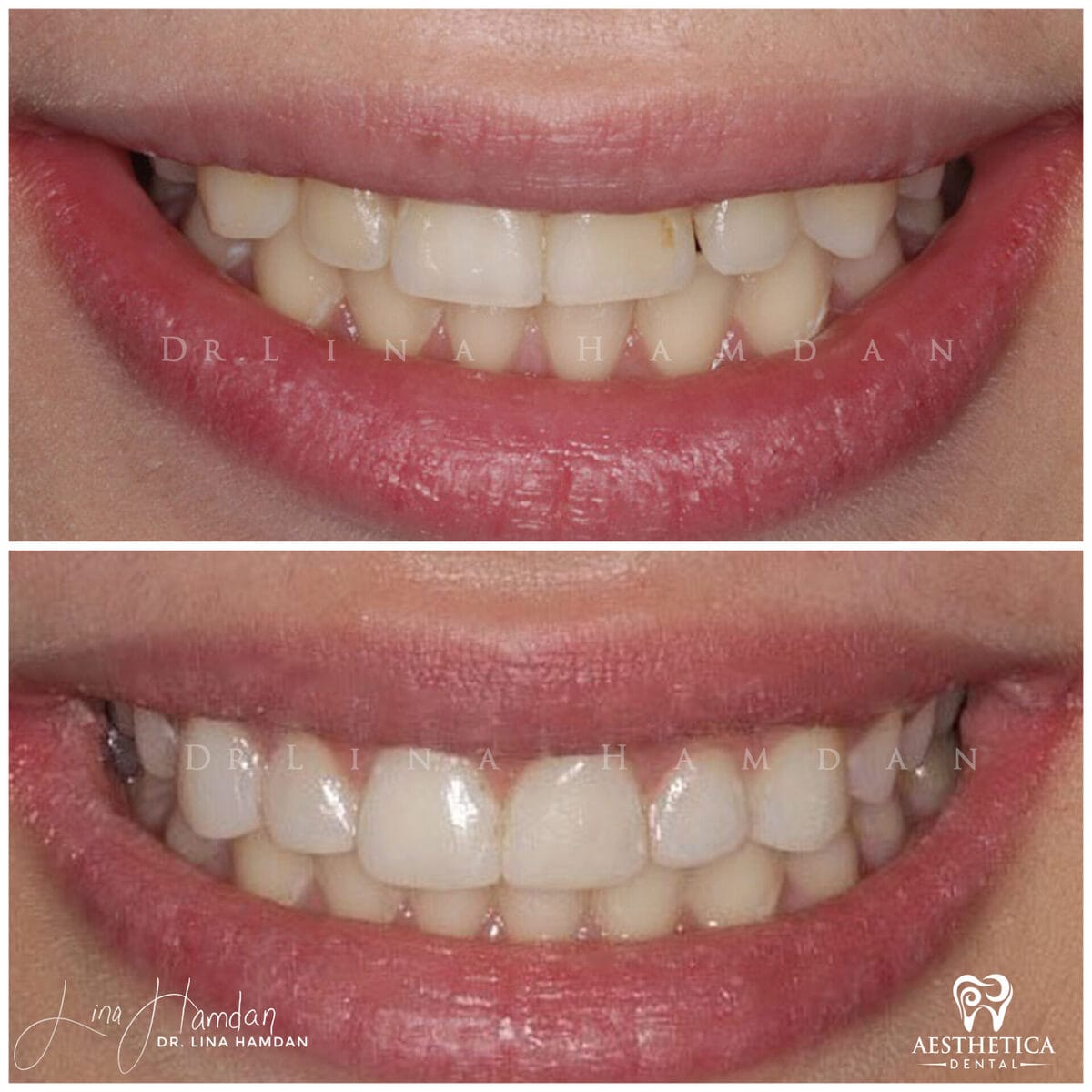 Composite bonding: anonymous case 96 from Aesthetica Dental Naperville
