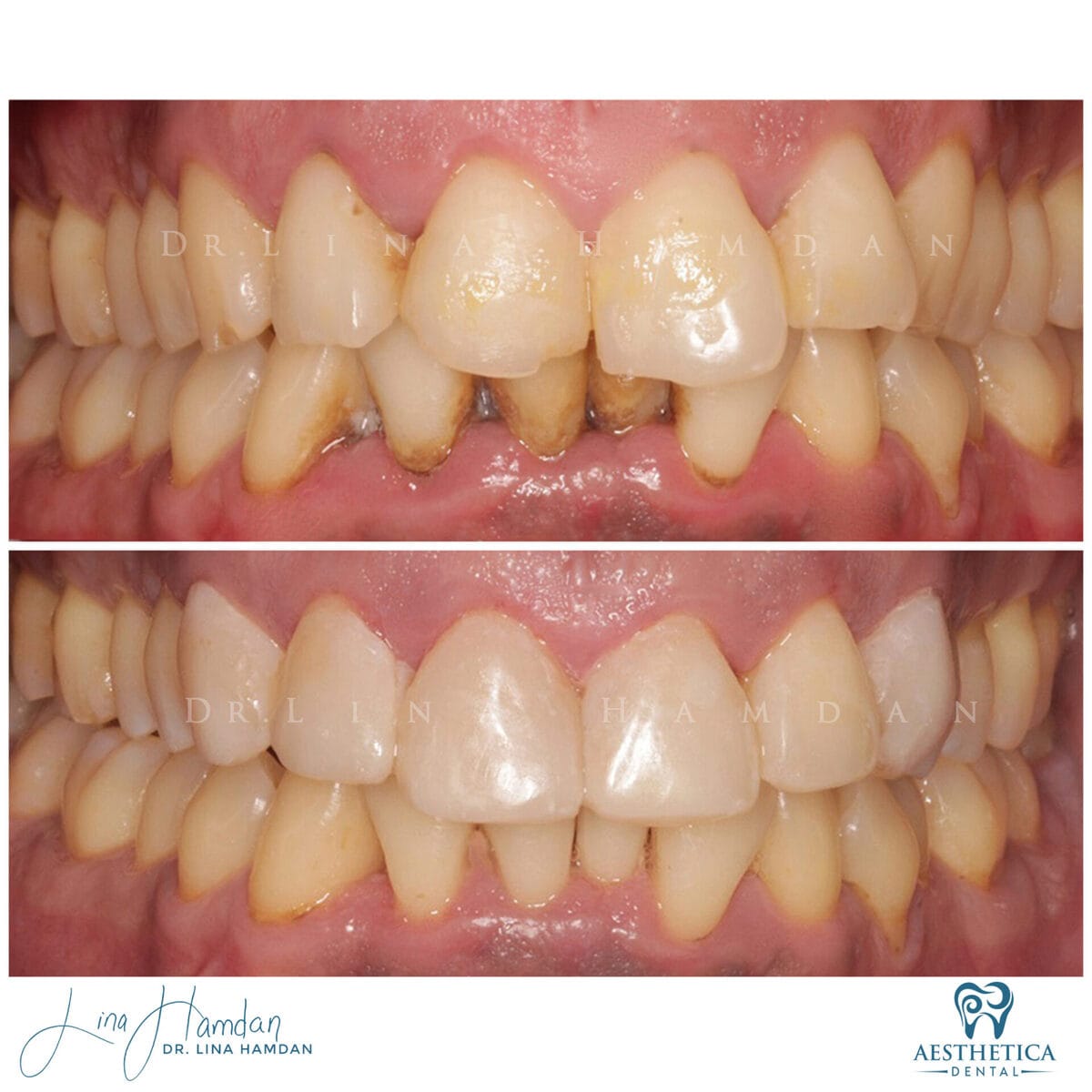 Composite bonding: anonymous case 103 from Aesthetica Dental Naperville