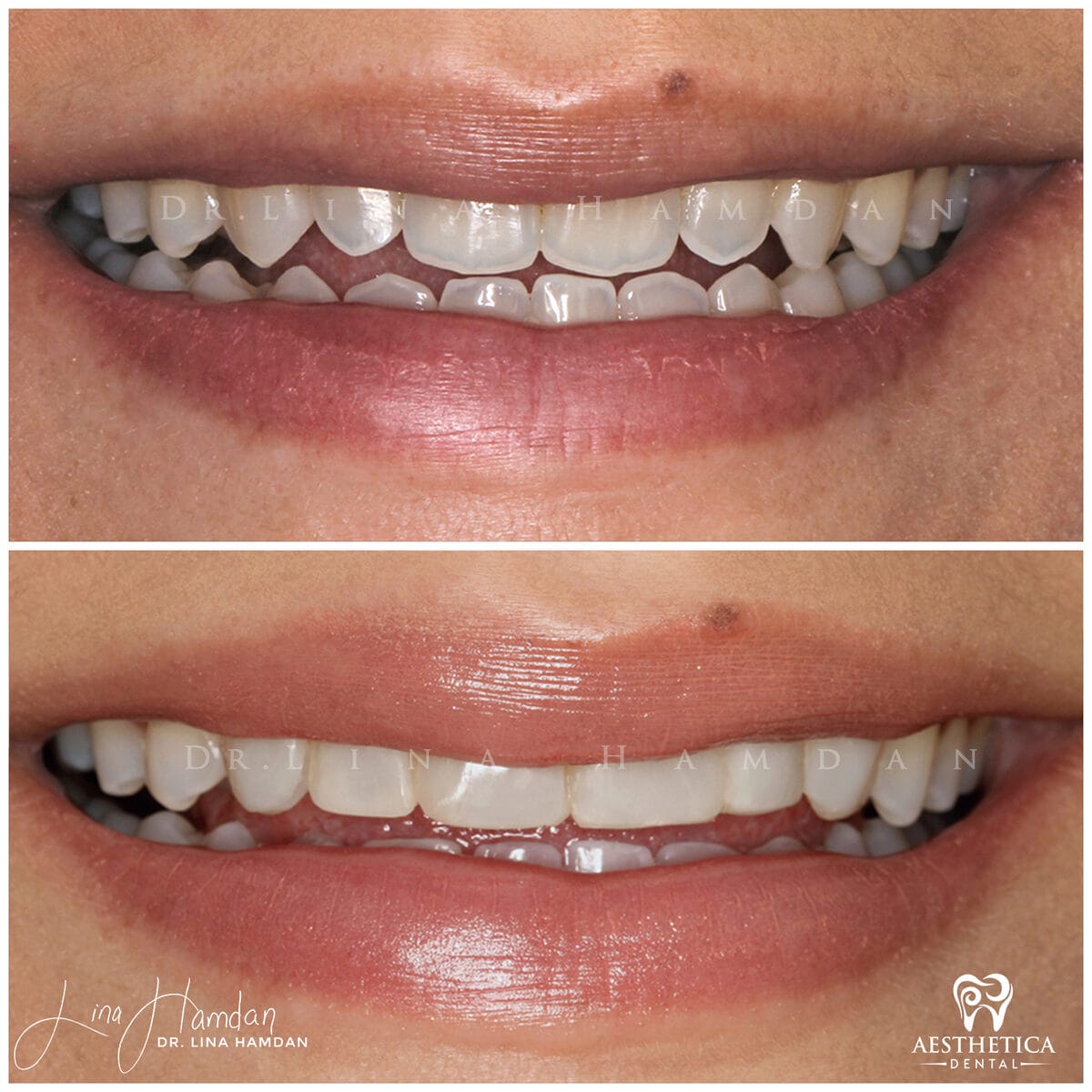 Composite bonding: anonymous case 123 from Aesthetica Dental Naperville