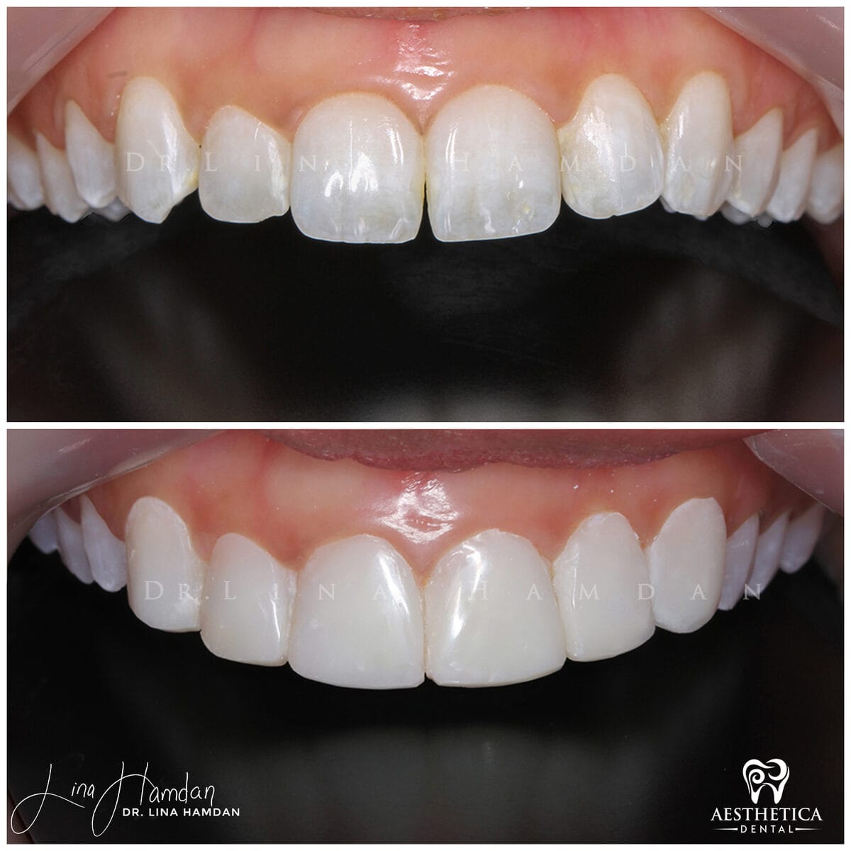 Composite bonding: anonymous case 131 from Aesthetica Dental Naperville