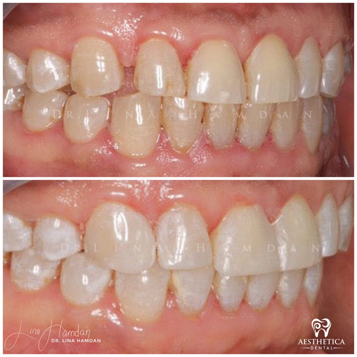 Composite bonding: anonymous case 135 from Aesthetica Dental Naperville
