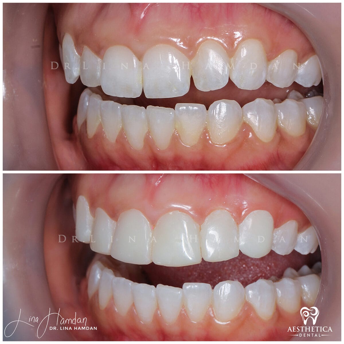 Composite bonding: anonymous case 152 from Aesthetica Dental Naperville