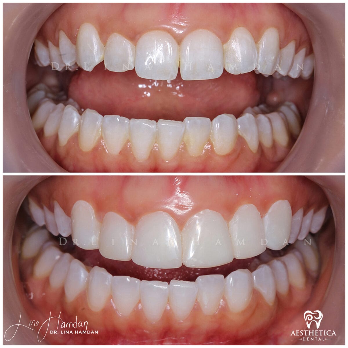 Composite bonding: anonymous case 154 from Aesthetica Dental Naperville