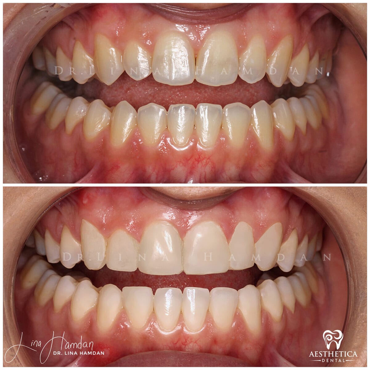Composite bonding: anonymous case 155 from Aesthetica Dental Naperville