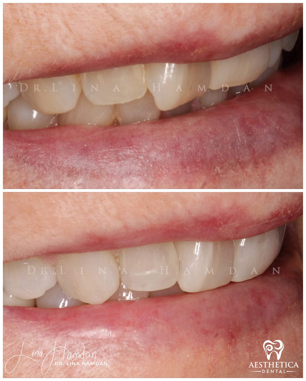 Inman Aligner result, anonymous patient at Aesthetica Dental Naperville (case 2, 2025-01-1-63)
