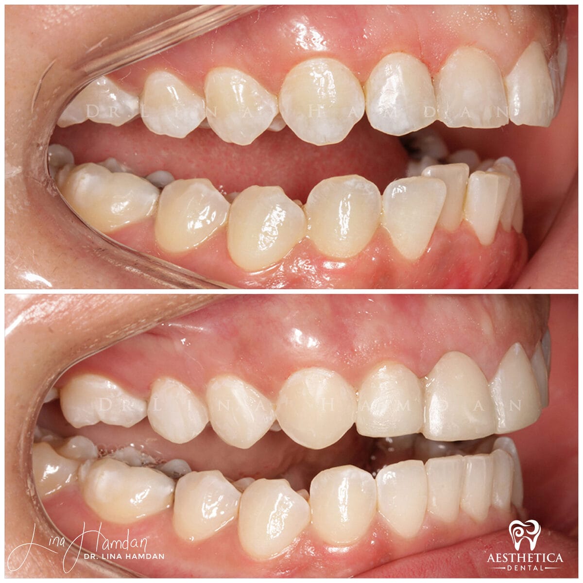 Inman aligners: anonymous case 13 from Aesthetica Dental Naperville