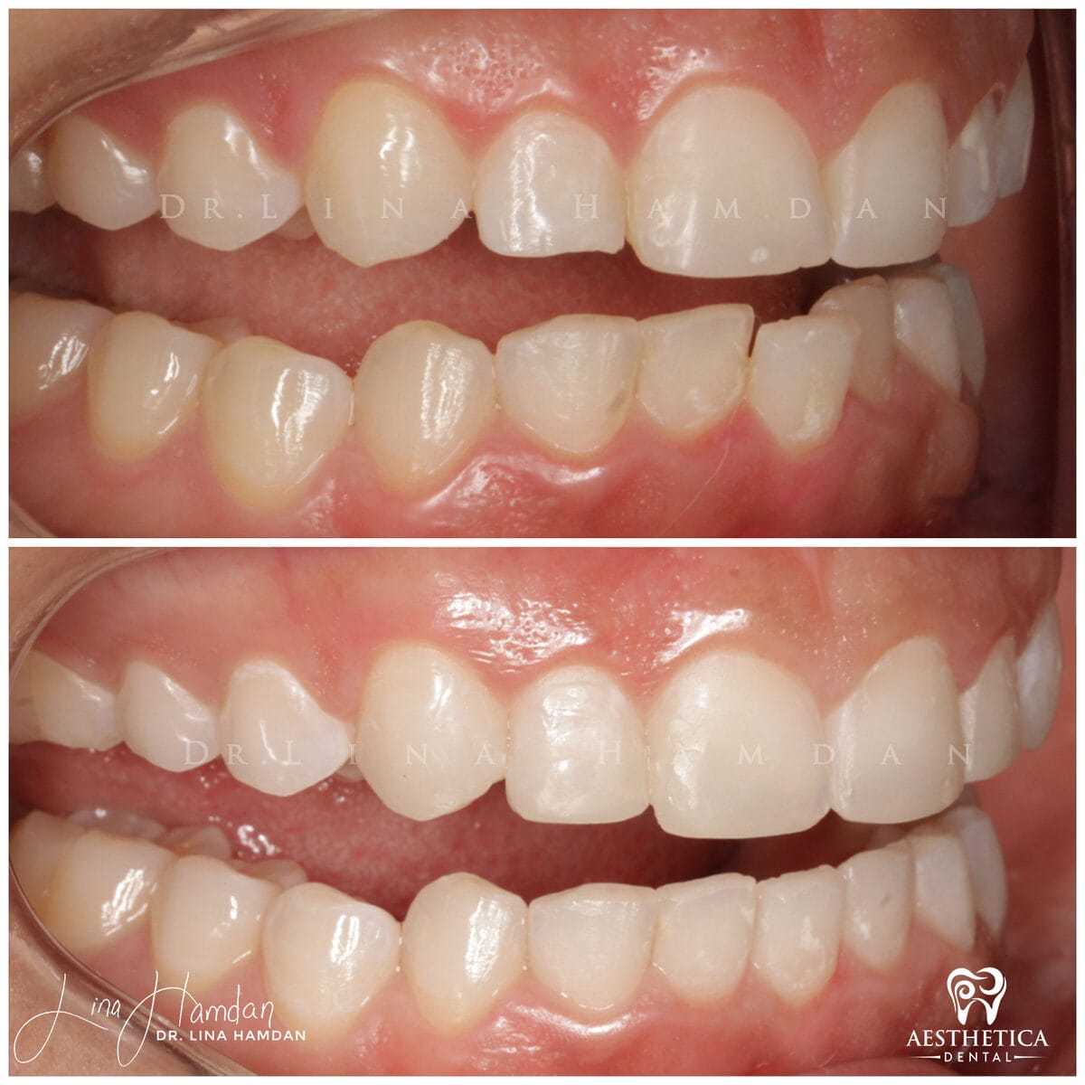 Inman aligners: anonymous case 17 from Aesthetica Dental Naperville
