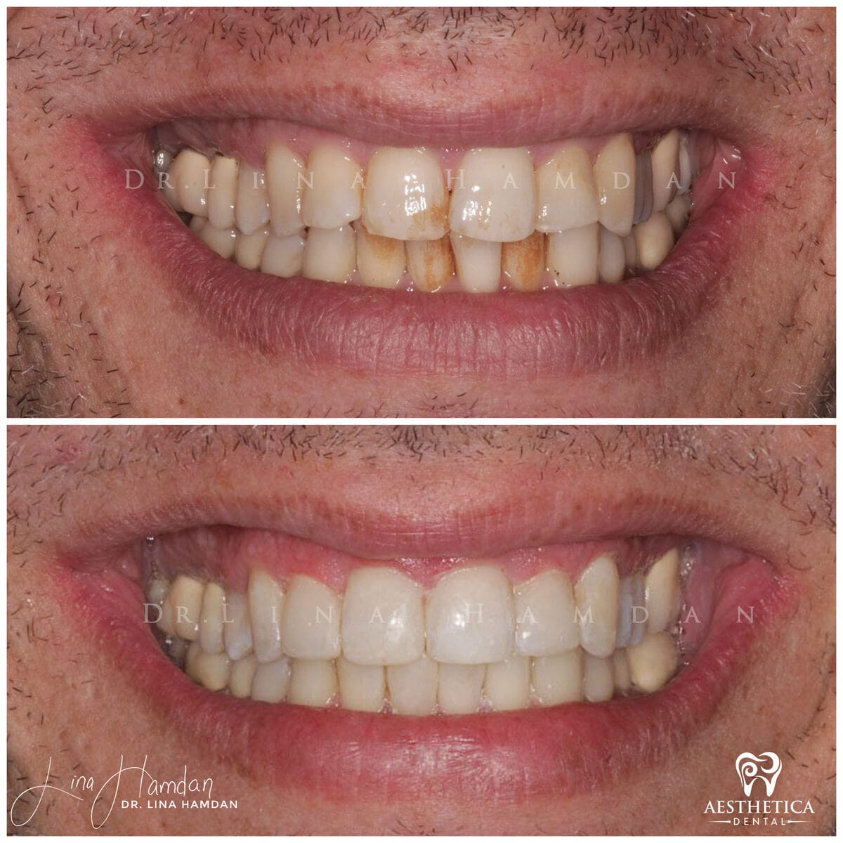 Inman aligners: anonymous case 25 from Aesthetica Dental Naperville