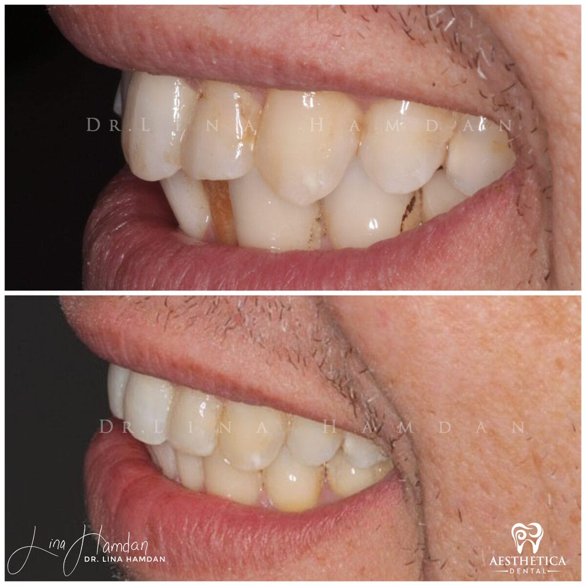 Inman aligners: anonymous case 33 from Aesthetica Dental Naperville