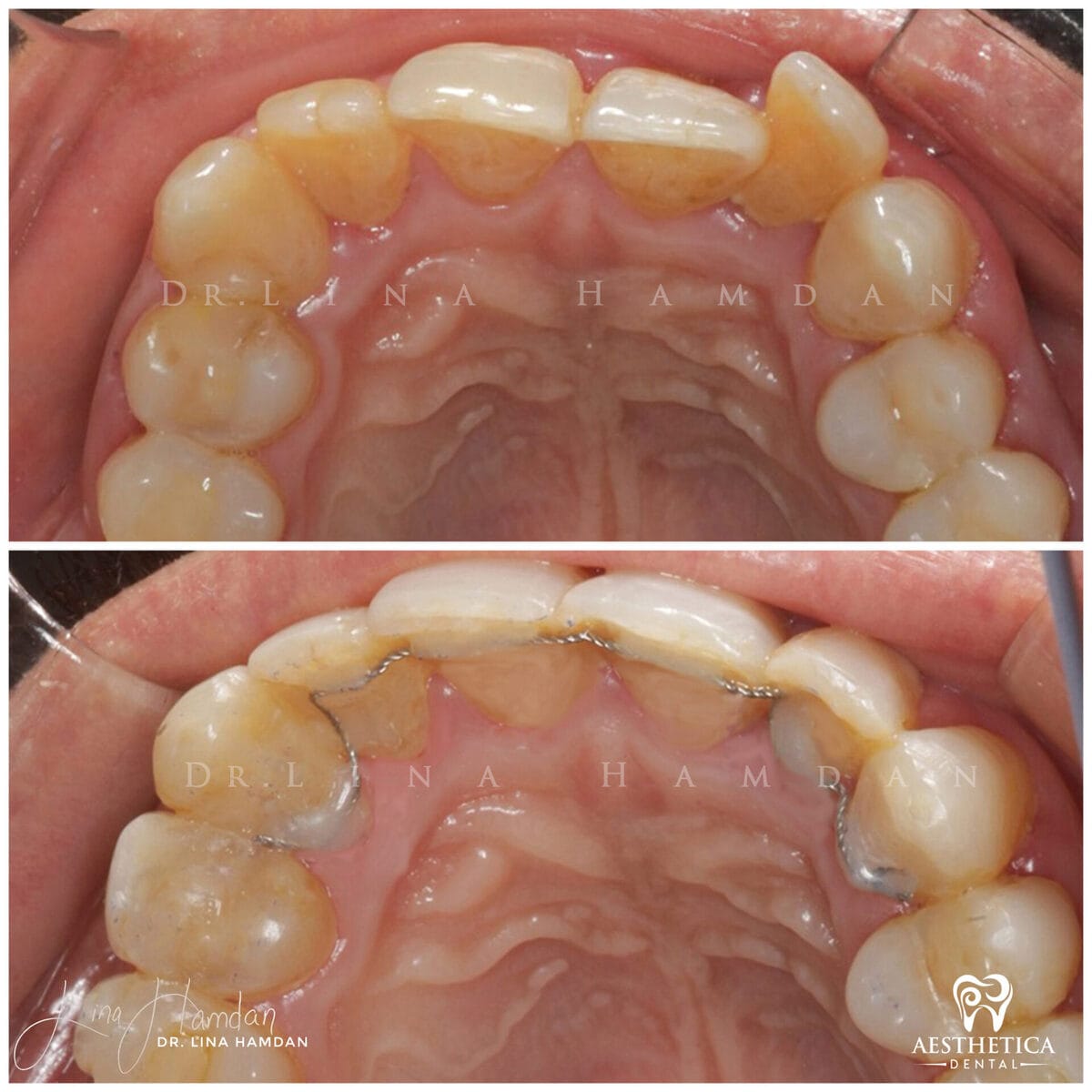 Inman aligners: anonymous case 42 from Aesthetica Dental Naperville