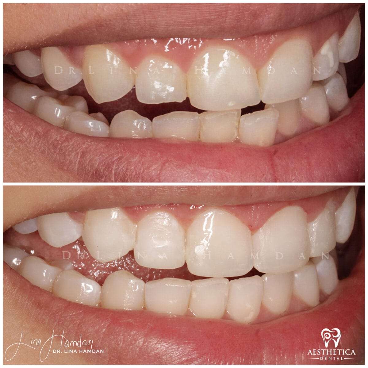 Inman aligners: anonymous case 44 from Aesthetica Dental Naperville