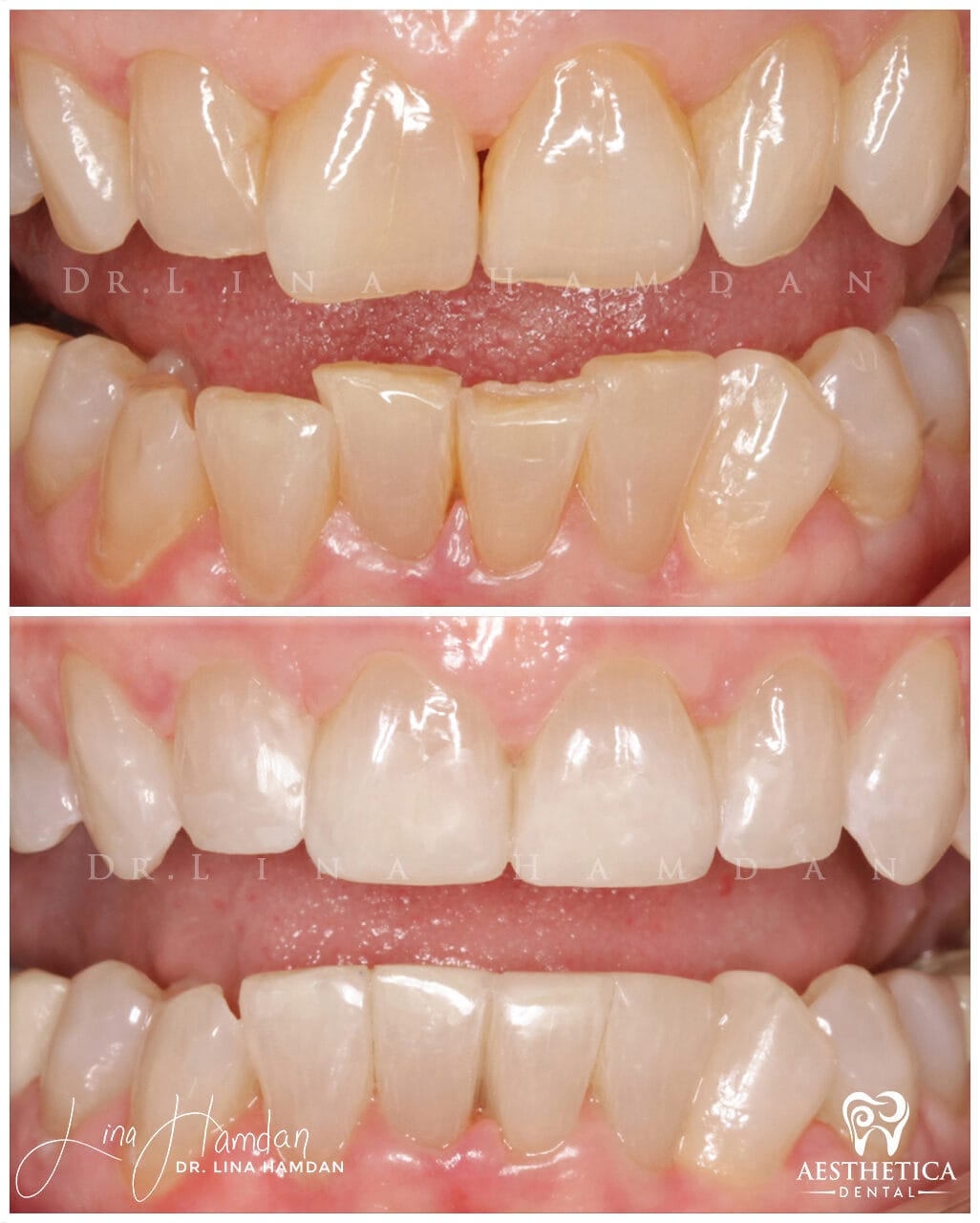 Inman aligners: anonymous case 46 from Aesthetica Dental Naperville