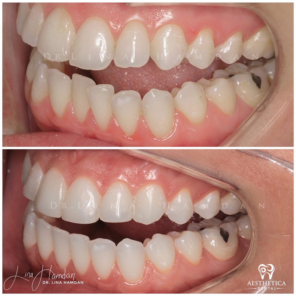 Inman aligners: anonymous case 58 from Aesthetica Dental Naperville