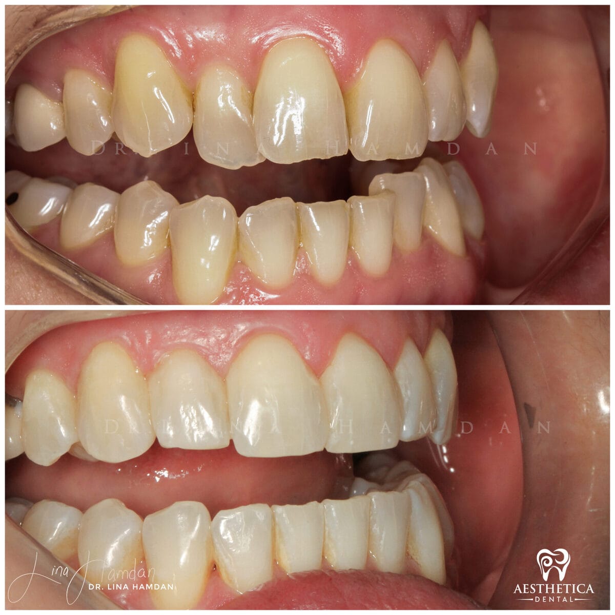 Invisalign clear aligner result, anonymous patient at Aesthetica Dental Naperville (case 6, 2025-01-13-4)