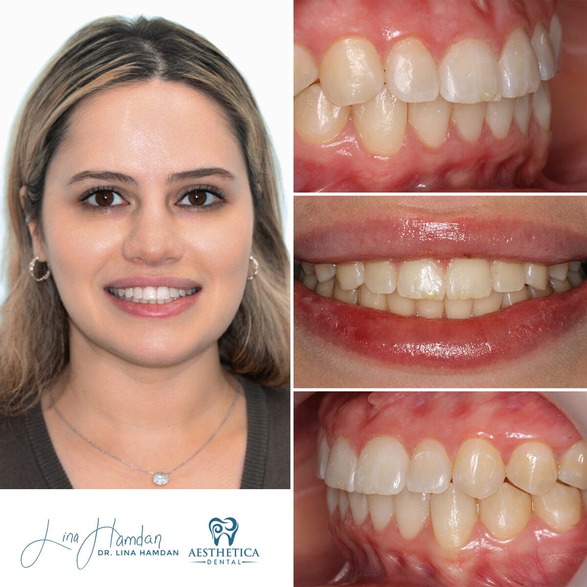 Clear aligners, quietly handled: anonymous case 39 from Aesthetica Dental Naperville