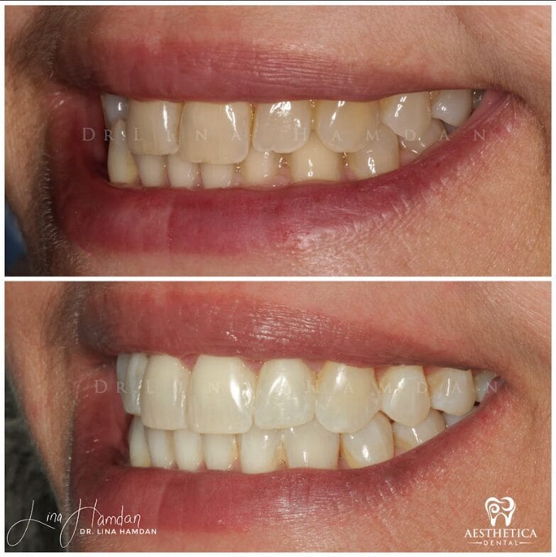 Clear aligners, quietly handled: anonymous case 60 from Aesthetica Dental Naperville