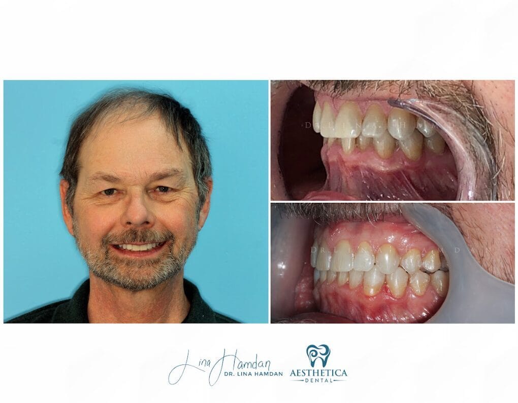 Clear aligners, quietly handled: anonymous case 70 from Aesthetica Dental Naperville