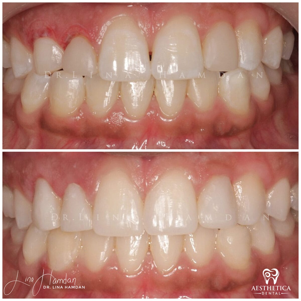 Periodontal treatment.: anonymous before-and-after case photograph from Aesthetica Dental Naperville
