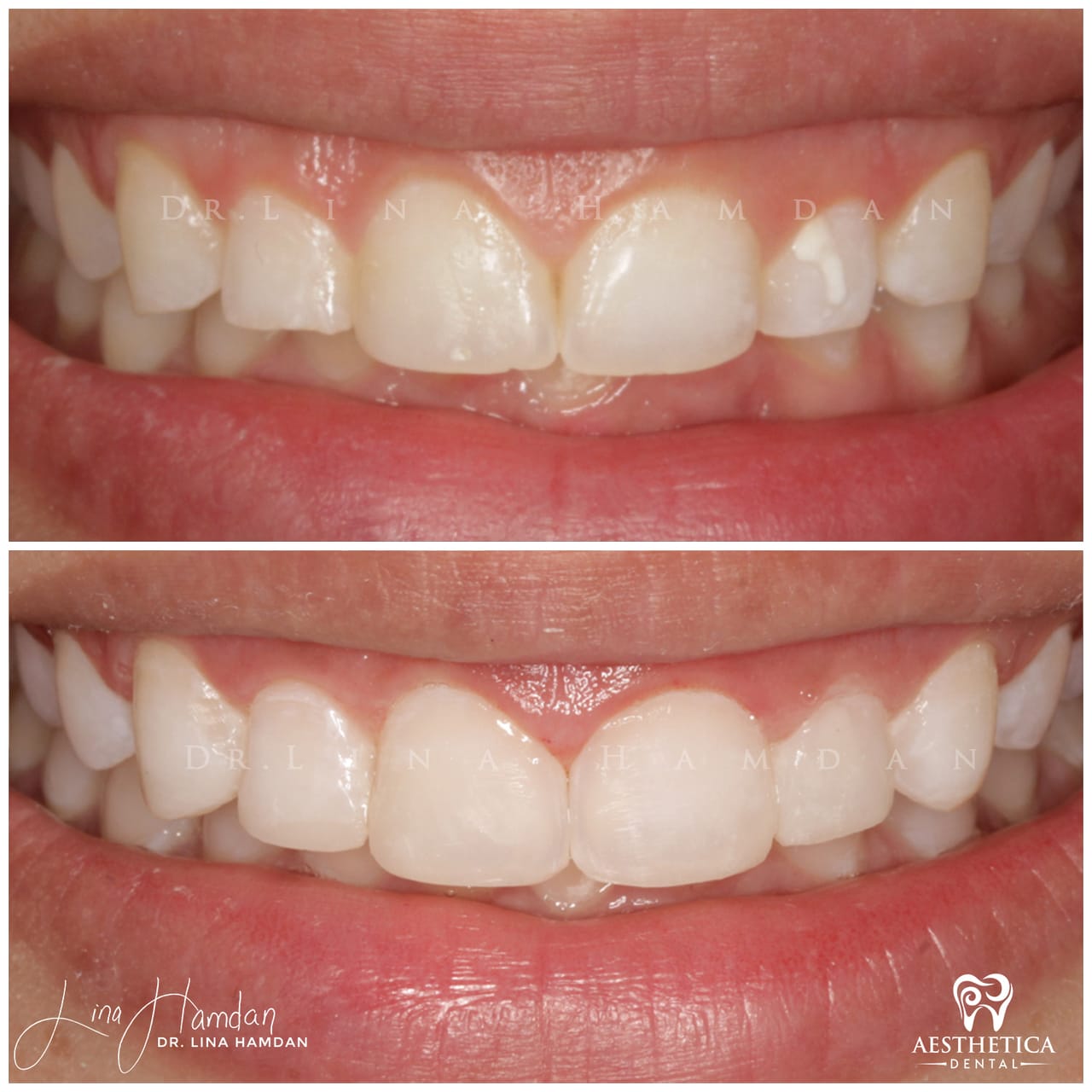 Smile makeover before and after, anonymous patient at Dr. Lina Hamdan Naperville (case 3, 2025-01-1-4)