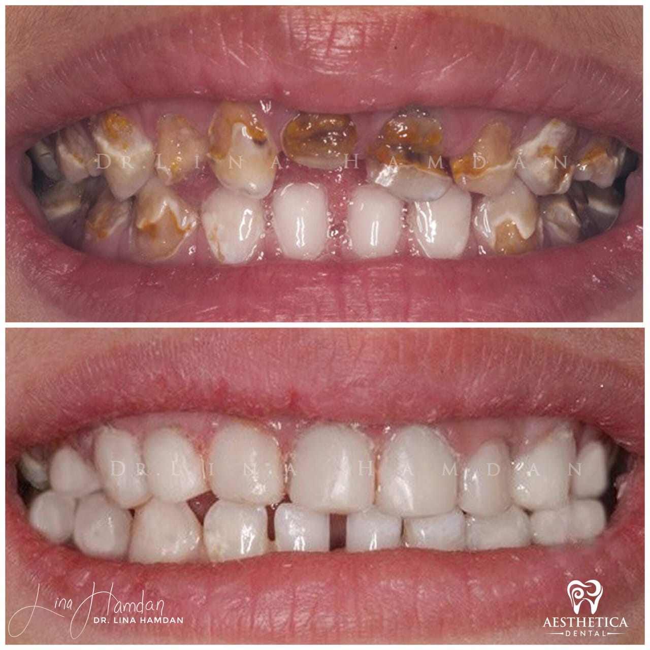 Smile makeover before and after, anonymous patient at Dr. Lina Hamdan Naperville (case 4, 2025-01-1-67)
