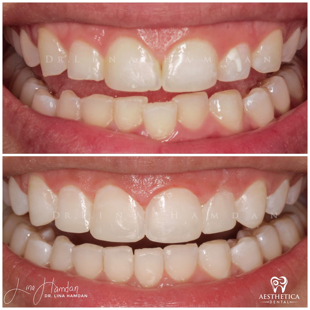 Smile makeover before and after, anonymous patient at Dr. Lina Hamdan Naperville (case 6, 2025-01-2-4)