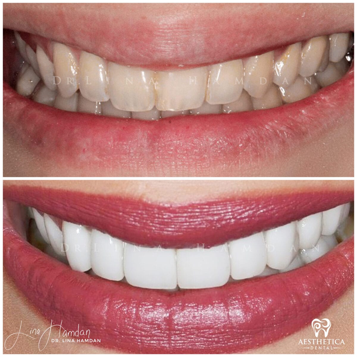 Porcelain veneers result, anonymous patient at Aesthetica Dental Naperville (case 2, 2025-01-1-11)