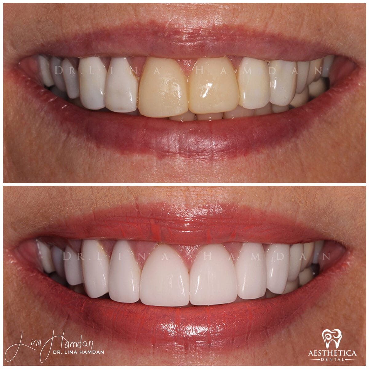 Porcelain veneers result, anonymous patient at Aesthetica Dental Naperville (case 3, 2025-01-1-12)