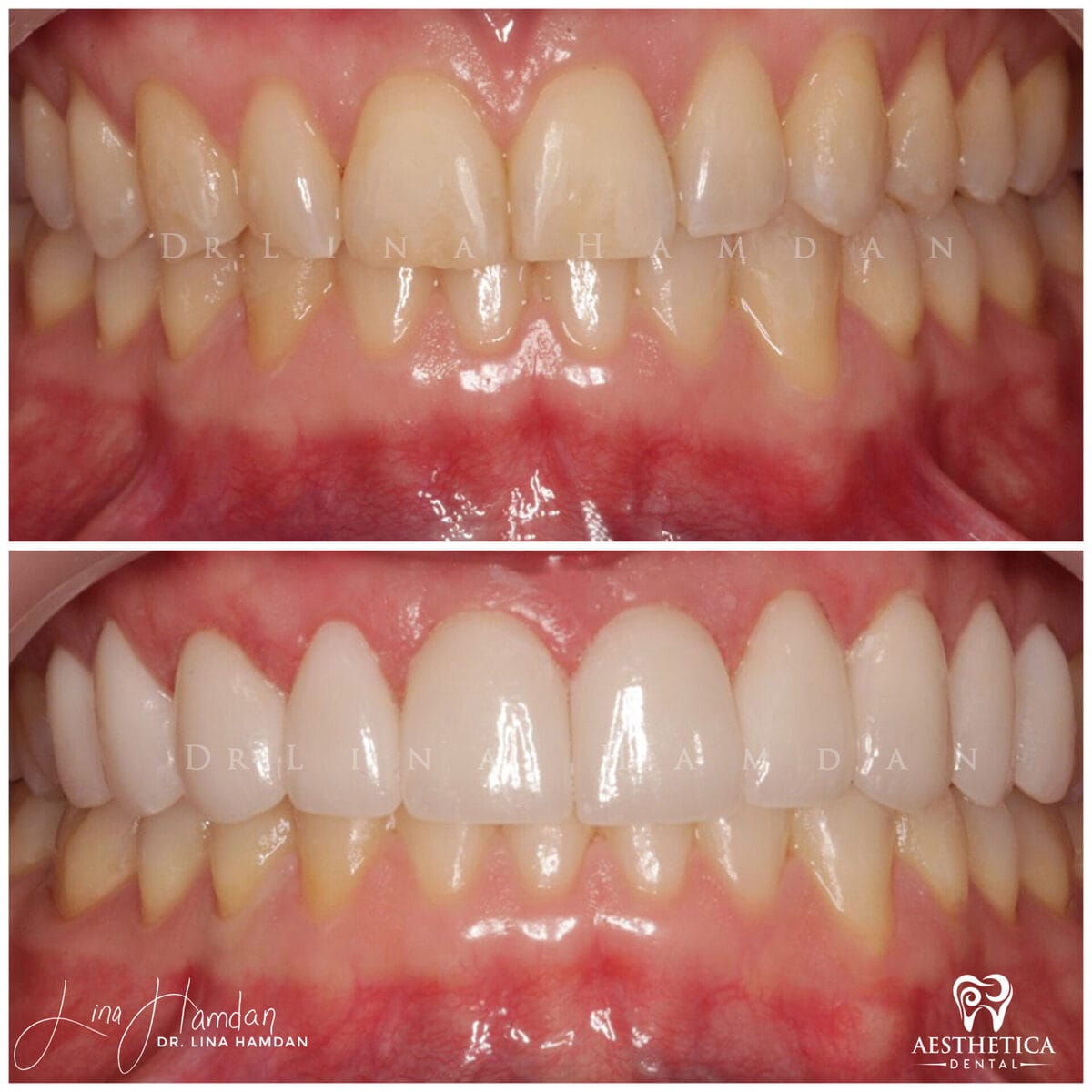 Porcelain veneers result, anonymous patient at Aesthetica Dental Naperville (case 4, 2025-01-1-13)
