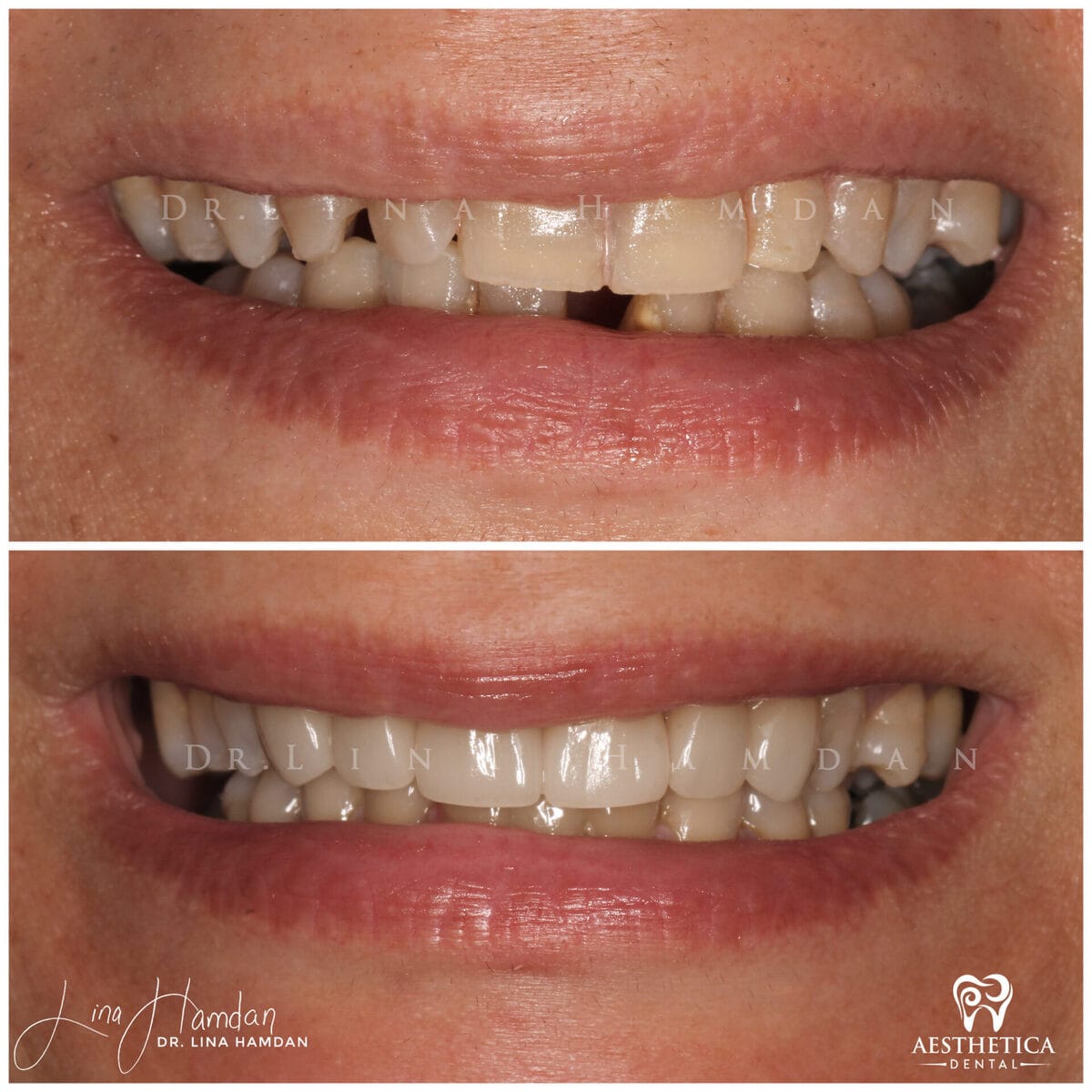 Porcelain veneers result, anonymous patient at Aesthetica Dental Naperville (case 6, 2025-01-1-15)