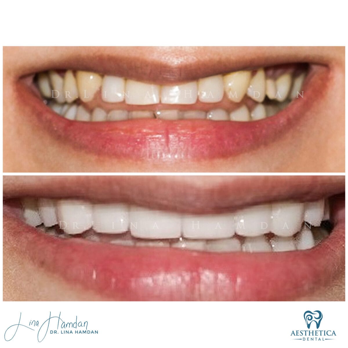 Porcelain veneers result, anonymous patient at Aesthetica Dental Naperville (case 8, 2025-01-1-17)