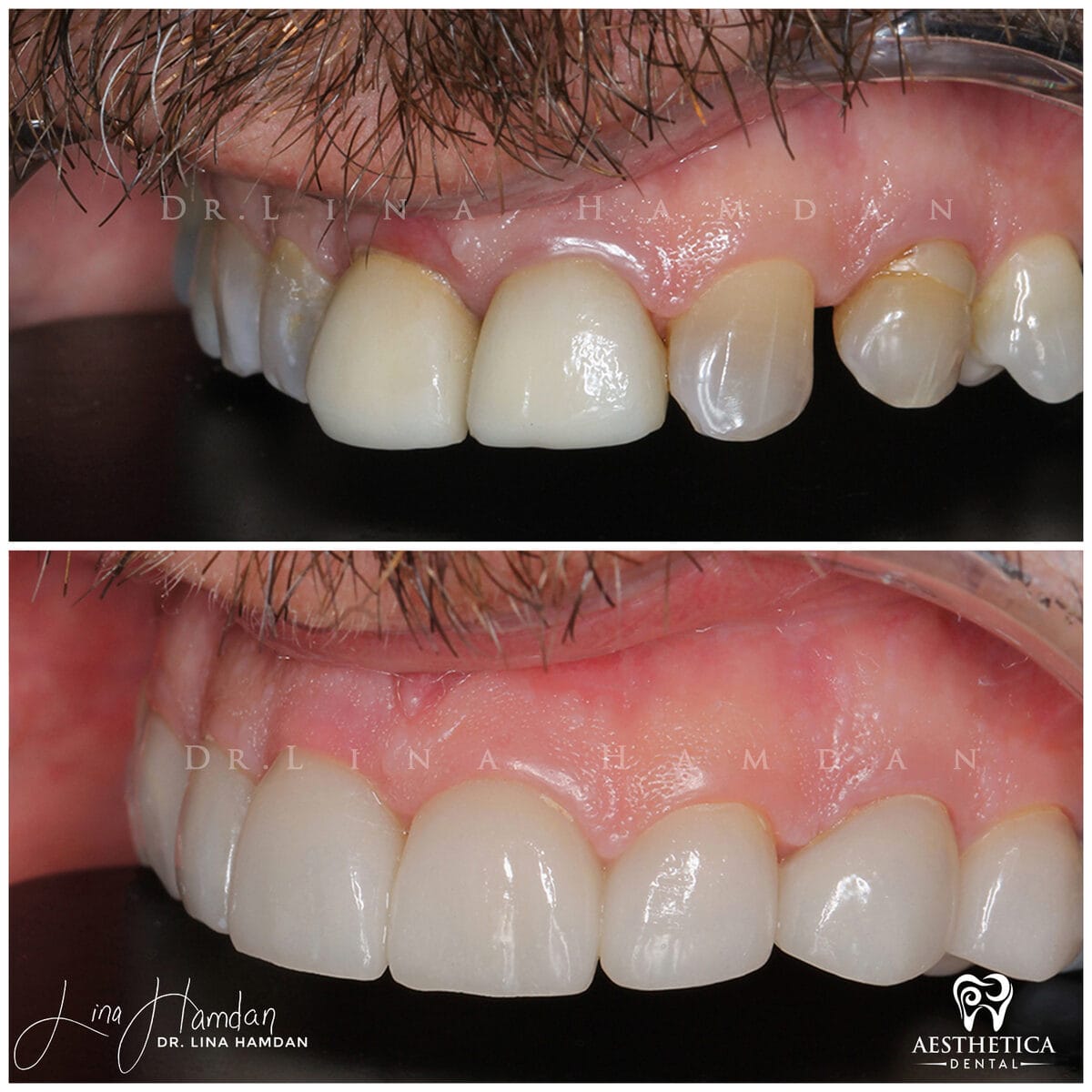 Porcelain veneers result, anonymous patient at Aesthetica Dental Naperville (case 12, 2025-01-10-8)