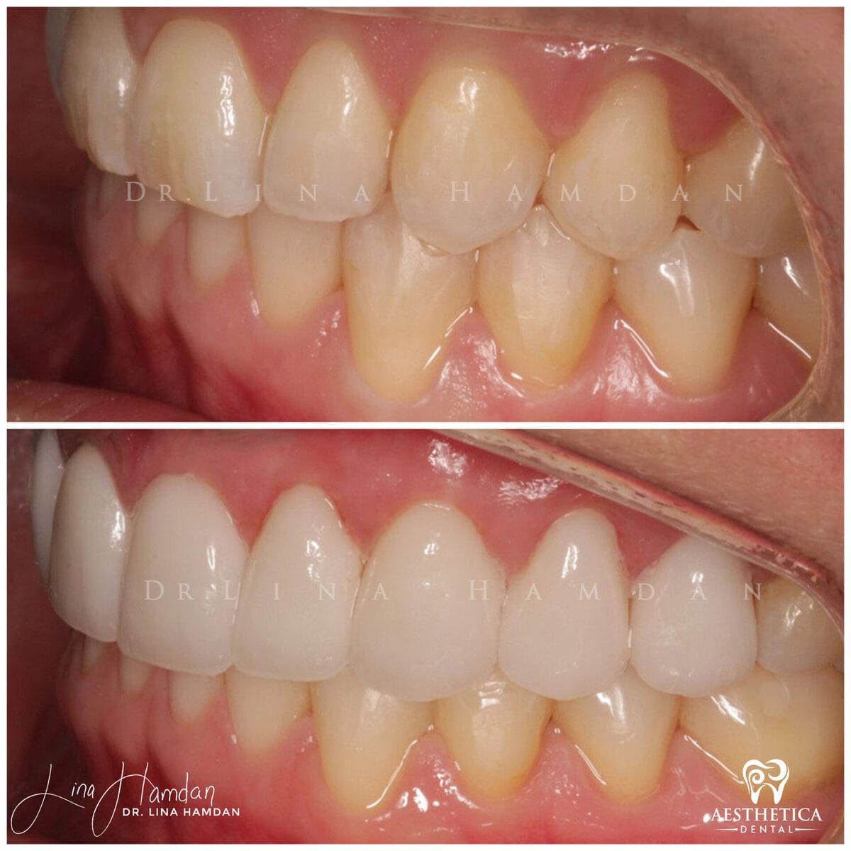 Considered porcelain veneers: anonymous case 24 from Aesthetica Dental Naperville