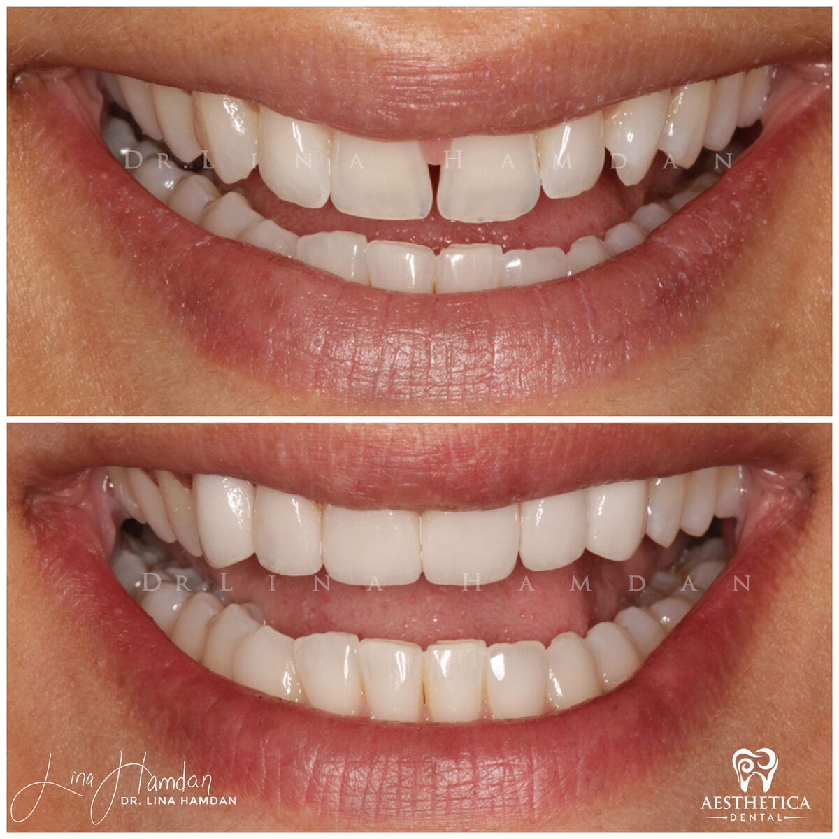 Considered porcelain veneers: anonymous case 25 from Aesthetica Dental Naperville