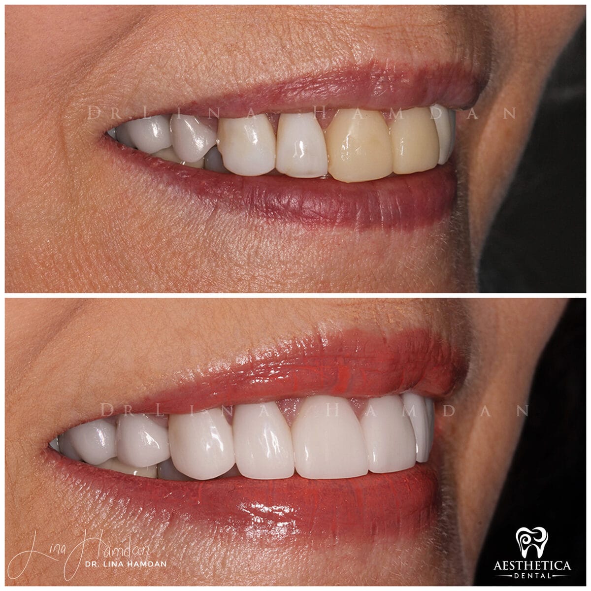Considered porcelain veneers: anonymous case 33 from Aesthetica Dental Naperville