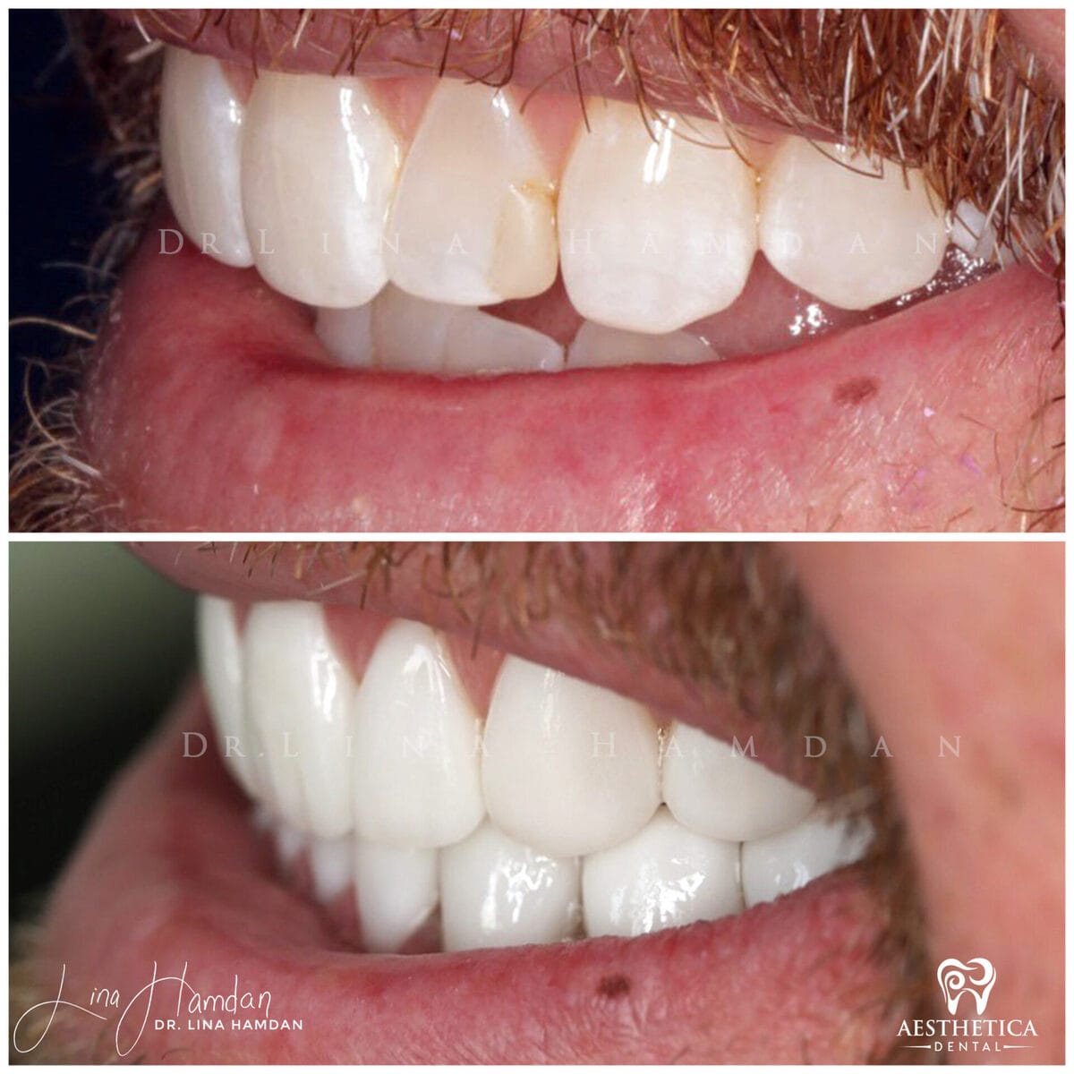 Considered porcelain veneers: anonymous case 36 from Aesthetica Dental Naperville