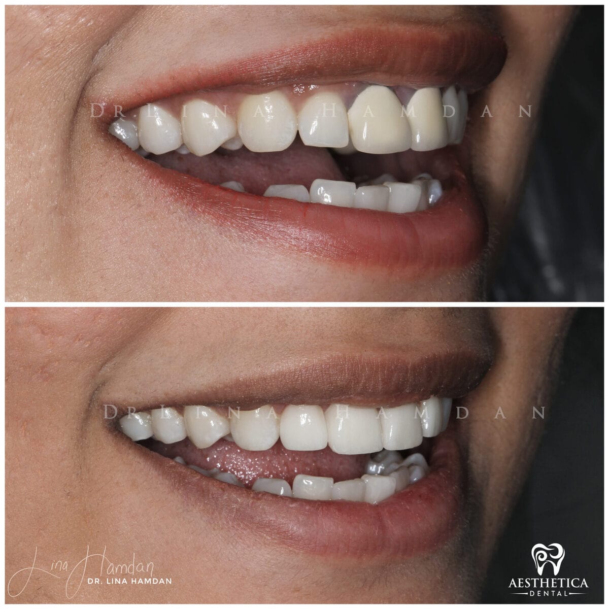 Considered porcelain veneers: anonymous case 46 from Aesthetica Dental Naperville