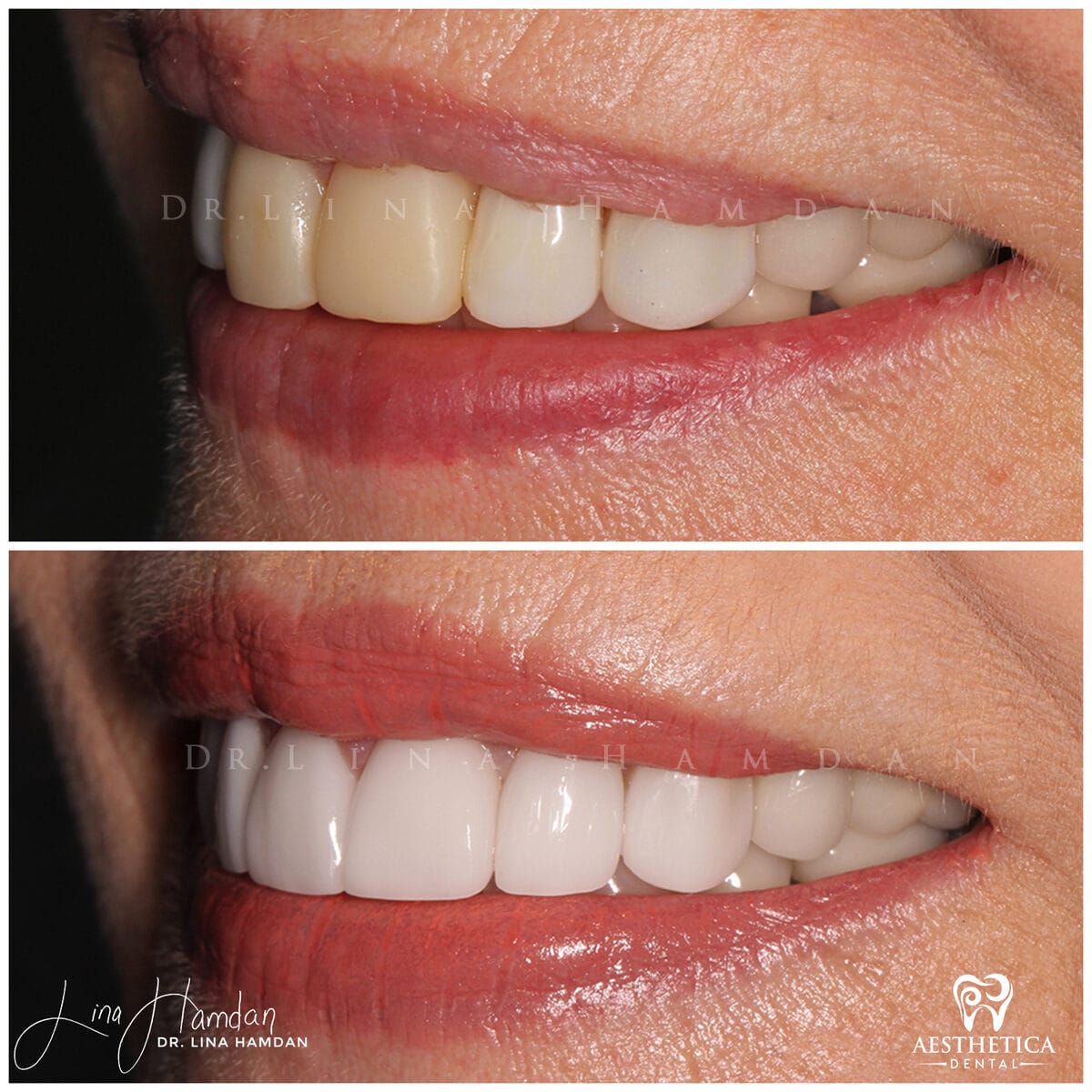 Considered porcelain veneers: anonymous case 47 from Aesthetica Dental Naperville