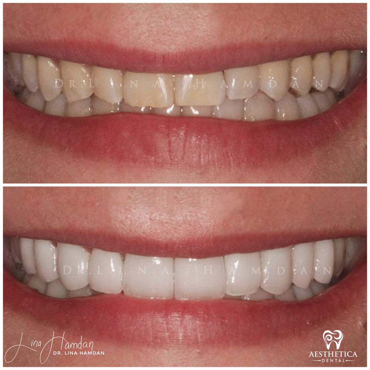 Considered porcelain veneers: anonymous case 48 from Aesthetica Dental Naperville