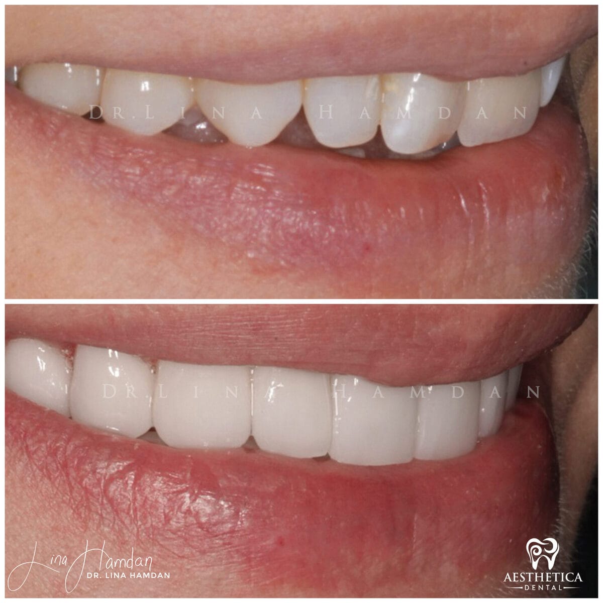 Considered porcelain veneers: anonymous case 85 from Aesthetica Dental Naperville