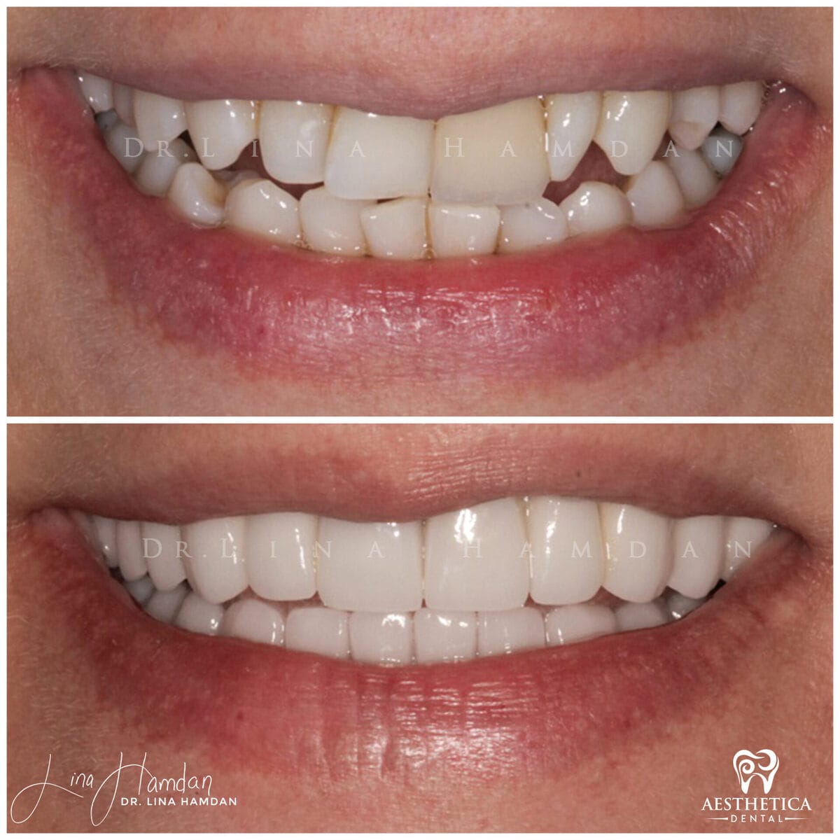 Considered porcelain veneers: anonymous case 89 from Aesthetica Dental Naperville