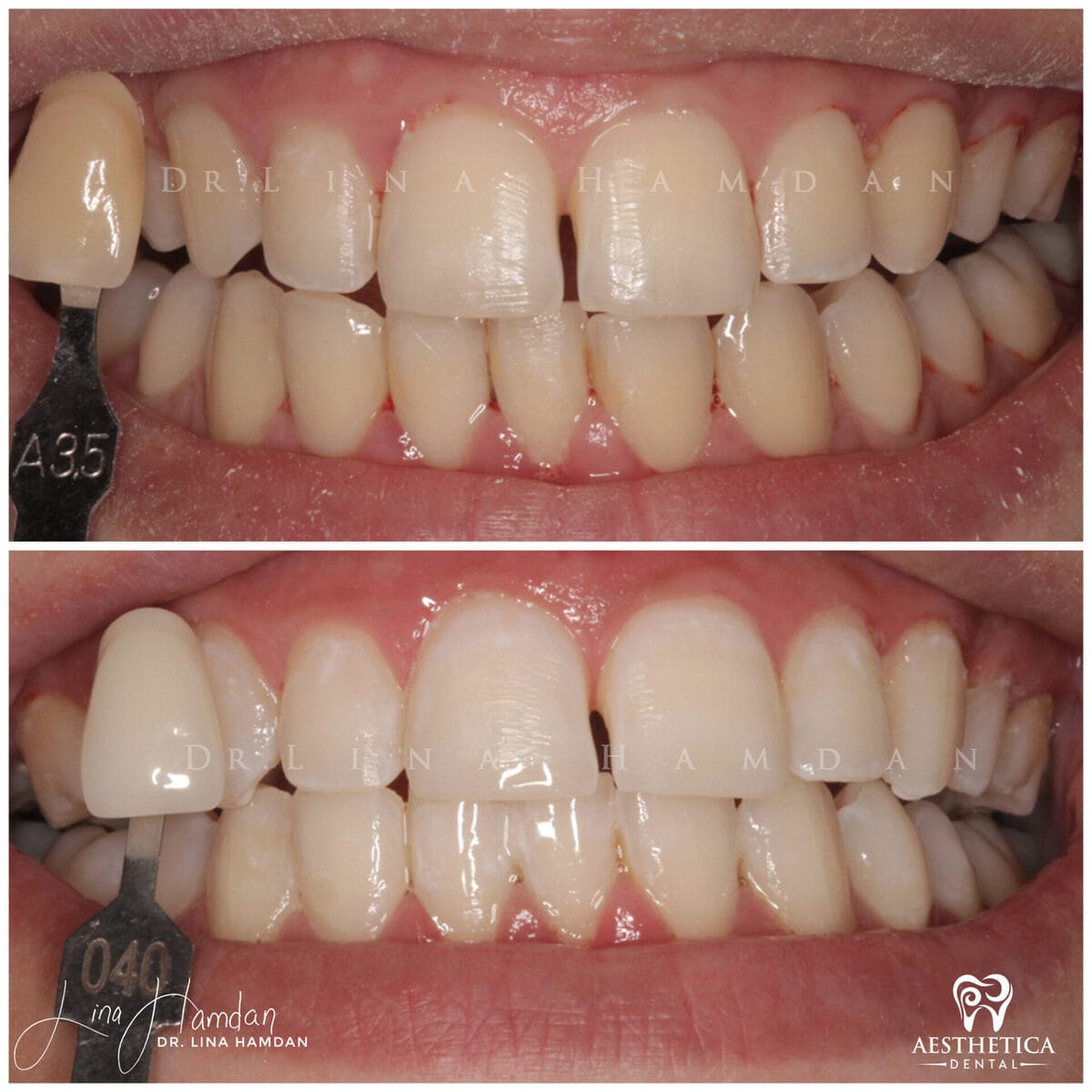 Teeth whitening: anonymous case 5 from Aesthetica Dental Naperville