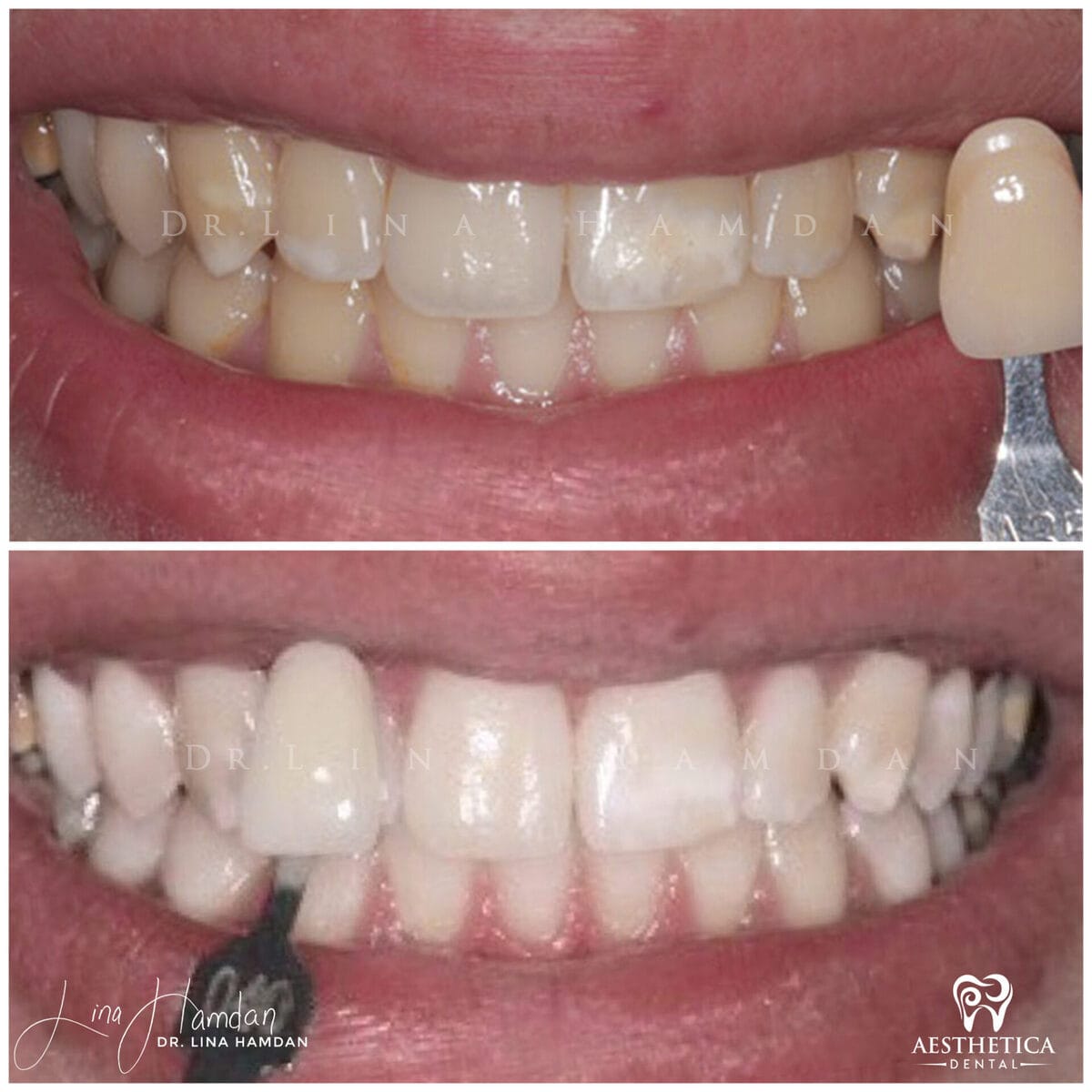 Teeth whitening: anonymous case 6 from Aesthetica Dental Naperville