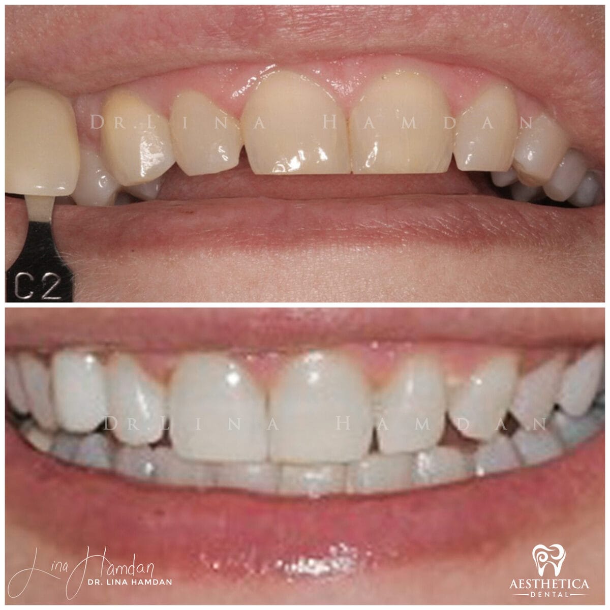 Teeth whitening: anonymous case 10 from Aesthetica Dental Naperville
