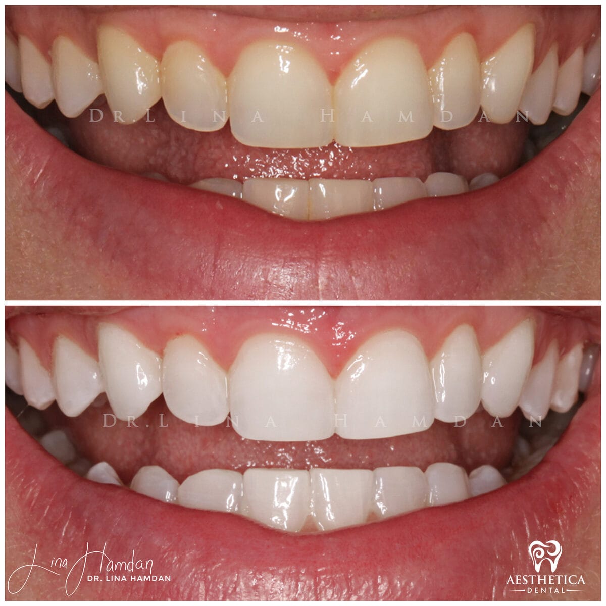 Teeth whitening: anonymous case 11 from Aesthetica Dental Naperville