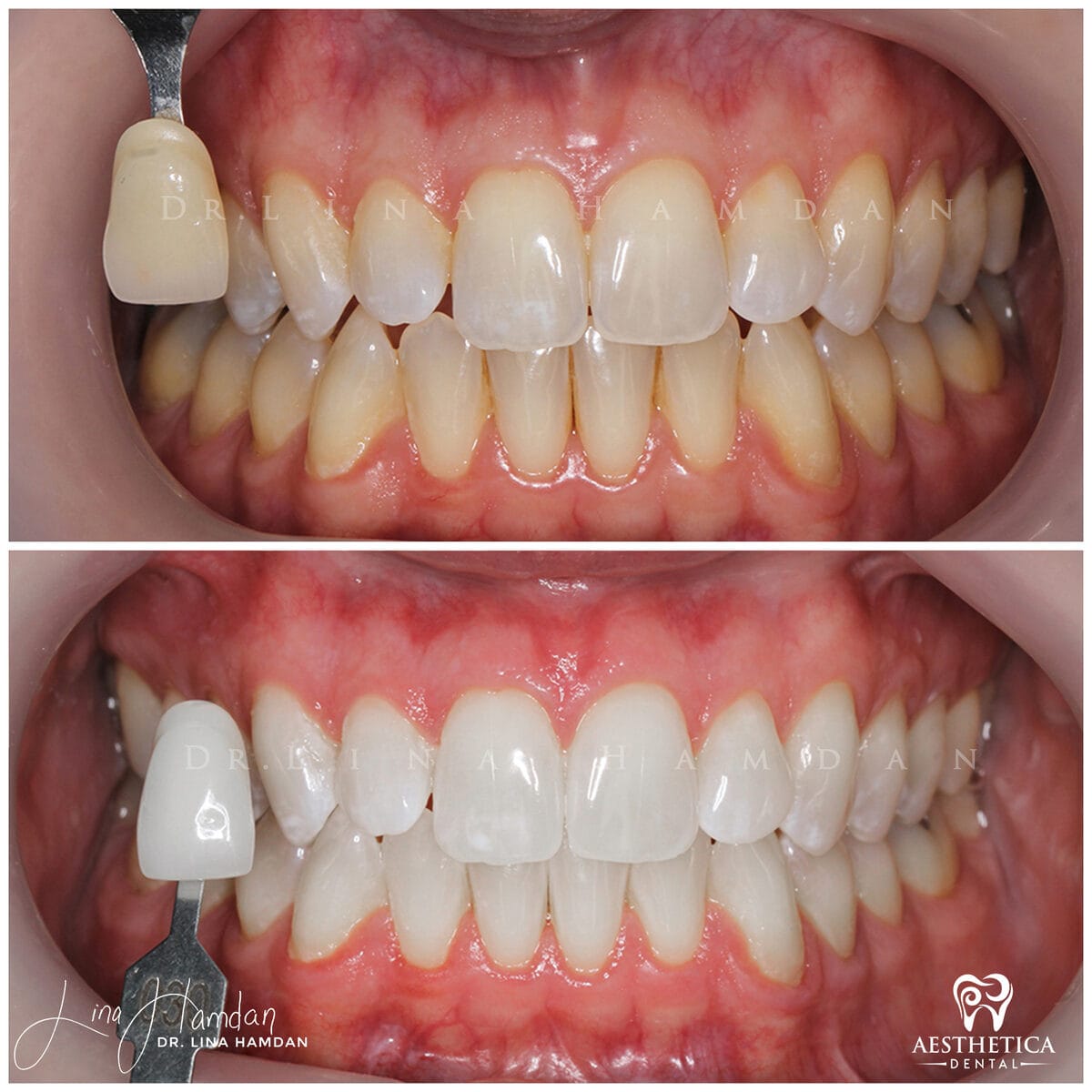 Teeth whitening: anonymous case 12 from Aesthetica Dental Naperville