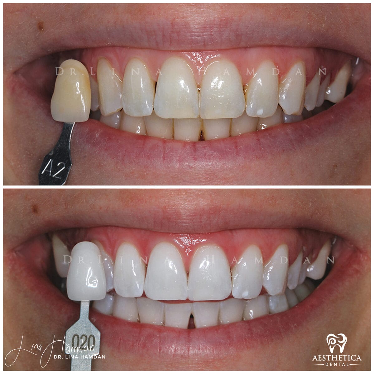Teeth whitening: anonymous case 16 from Aesthetica Dental Naperville